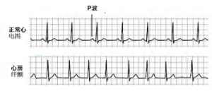 心电图比较：房颤心电图显示P波消失，心律不规则