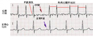 心房纤颤心电图：P波消失，众多小f波，R-R间期绝对不齐